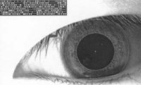 iris dilate